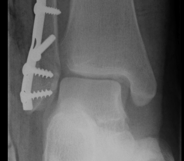 Ankle Fracture Fibula ORIF Increased Medial Clear Space